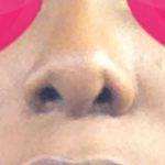 African American Nose Jobs Before And After (2)