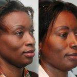 African American Nose Jobs Before And After (5)