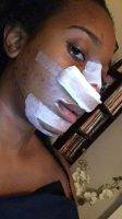 African American Nose Reshaping For Wide Nasal Ala
