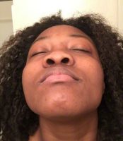 African American Nose Reshaping Result