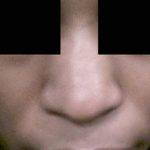 African American Nose Surgery Can Make Nostrills Appear Smaller