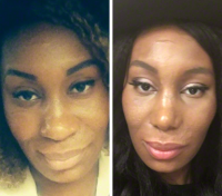 African American Nostril Surgery Before And After Photos