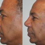 African American Rhinoplasty Before And After (2)