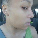 African American Rhinoplasty Before And After (3)