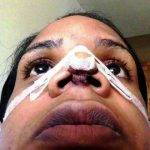 African American Rhinoplasty For Changing The Shape Of Bone And Cartilage Inside The Nose