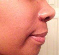 African American rhinoplasty patient with improvement in harmony between the nose and chin