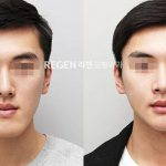 Asian Male Rhinoplasty Before After