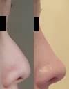 Asian Non Surgical Nose Job Before And After