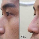 Asian Nose Augmentation For Man