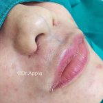 Asian Nose Beauty Surgery Usually Involves Restructuring The Nose, Particularly The Area Between The Nasal Tip And The Bridge
