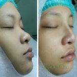 Asian Nose Bridge Augmentation Before And After Pictures (1)