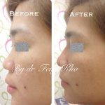 Asian Nose Bridge Augmentation Before And After Pictures (3)