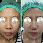 Asian Nose Bridge Augmentation Before And After Pictures (4)