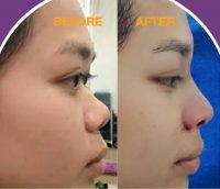 Asian Nose Job Can Change Deformities Or Make The Nose Slightly Smaller