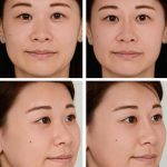 Asian Nose Job Experience Pictures
