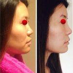 Asian Nose Job Is Done To Create A Natural Looking, Smooth, Symmetric Bridge Contour