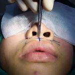 Asian Nose Jobs Result In A Less Defined Nose With A Slightly-rounded Nasal Tip