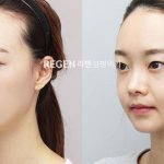 Asian Nose Plastic Surgery Before And After