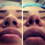 Asian Nose Plastic Surgery Before And After Photo Of Surgery