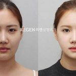 Asian Nose Surgery Before And After Pics
