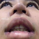 Asian Nose Surgery Increases The Overall Size Of The Nose And Balances The Width Of The Face