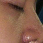 Asian Nose Surgery Scar Photo