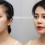 Asian Rhinoplasty Before After Photos