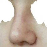 Asian Rhinoplasty Pictures