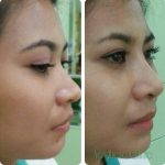Augmentation Nose Bridge Before And After (2)