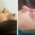 Augmentation Nose Bridge Before And After (3)