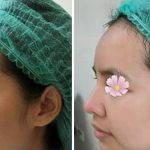 Augmentation Of Nose Before And After Photos (2)