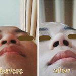 Augmentation Of Nose Before And After Photos (4)