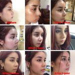 Augmentation Rhinoplasty Before And After Photos (5)