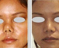 Augmentation Rhinoplasty Is Most Frequently Performed In Asian Patients