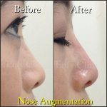 Autologous Implants For Nose Augmentation