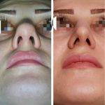 Before And After Bulbous Tip Rhinoplasty