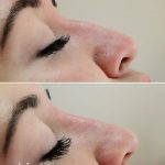Before And After Crooked Nose Repair Photos (2)