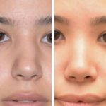 Before And After Crooked Nose Repair Photos (3)