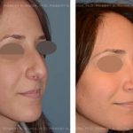 Before And After Crooked Nose Repair Photos (7)