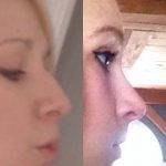 Before And After Crooked Nose Repair Photos (8)