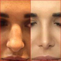 Before And After Nose Reshaping In Gold Coast