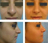 Before And After Rhinoplasty By Dr Grigoryants