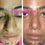 Before And After Septoplasty (1)