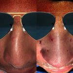 Before And After Septoplasty (3)