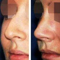 Best Rhinoplasty In Baltimore To Enhance The Nose And Improve Breathing Through The Nose