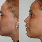 Black Rhinoplasty Before And After (2)