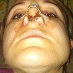 Bulbous Nose After Rhinoplasty