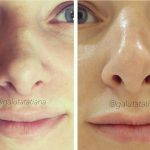 Bulbous Nose Before And After Nose Beaty Surgery (3)
