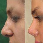 Bulbous Nose Before And After Nose Beaty Surgery (4)