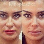 Bulbous Nose Before And After Nose Resha[ing (3)